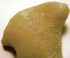 Jaw bone created from stem cells