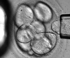 MS sufferer walks after stem cell treatment