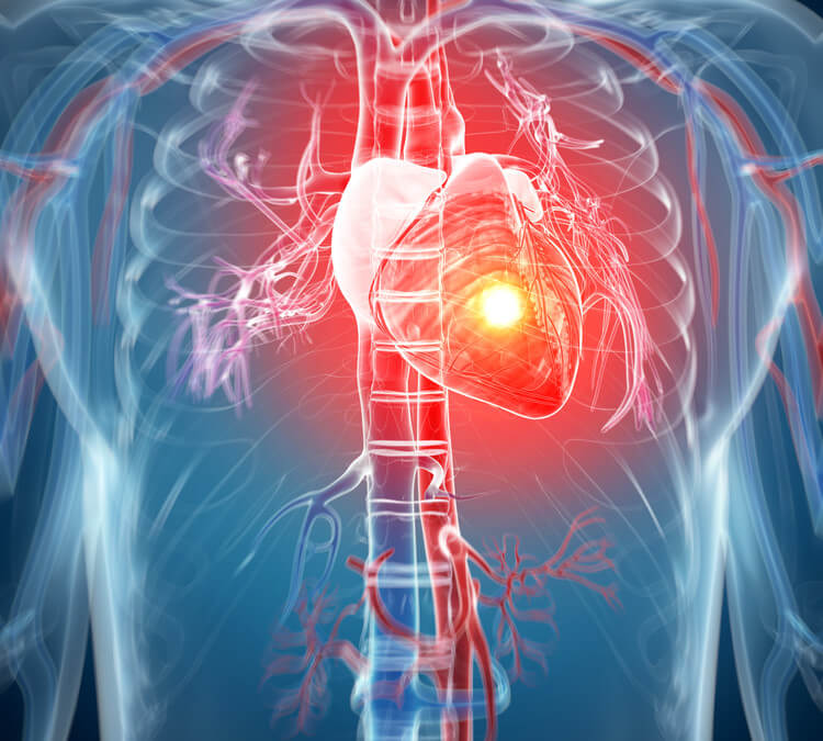 Angina Treated With Stem Cells In Small Study