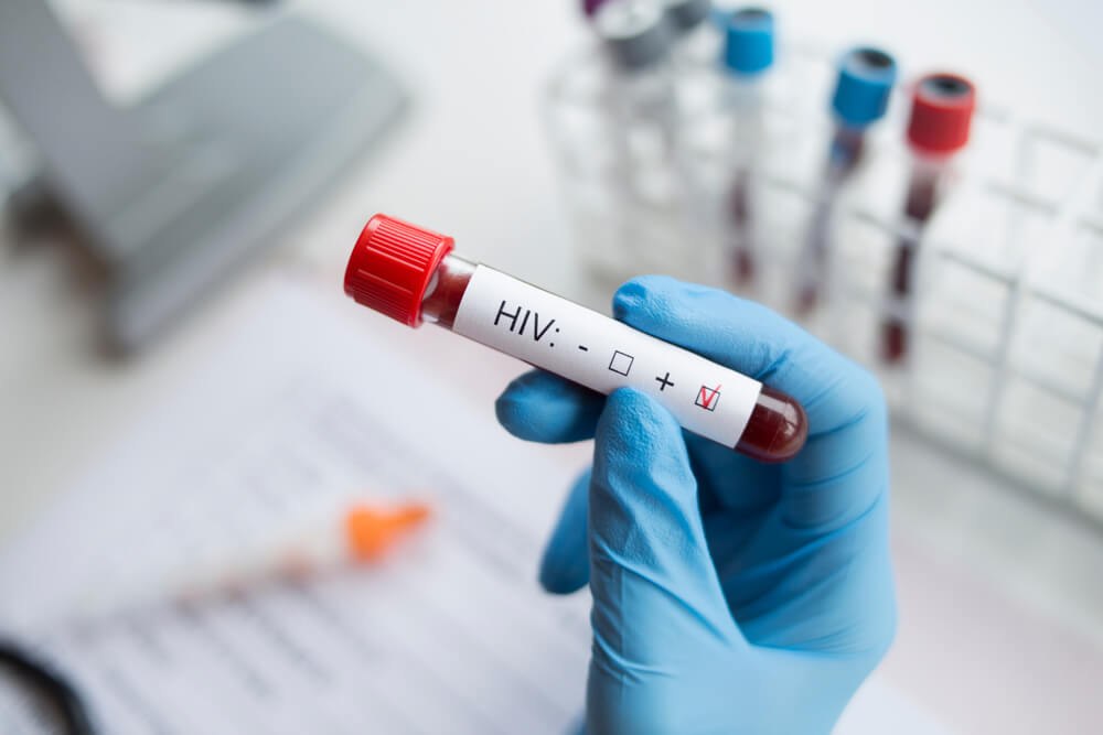 Vial of blood with HIV marked positive