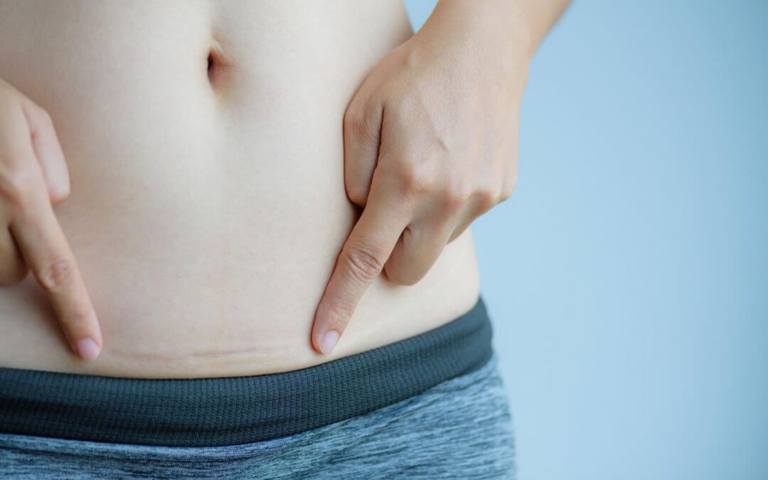 real image of a c-section scar once it has healed