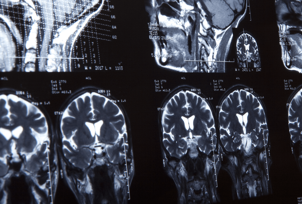 Pre-Made Stem Cell Treatment for Aggressive Brain Cancer