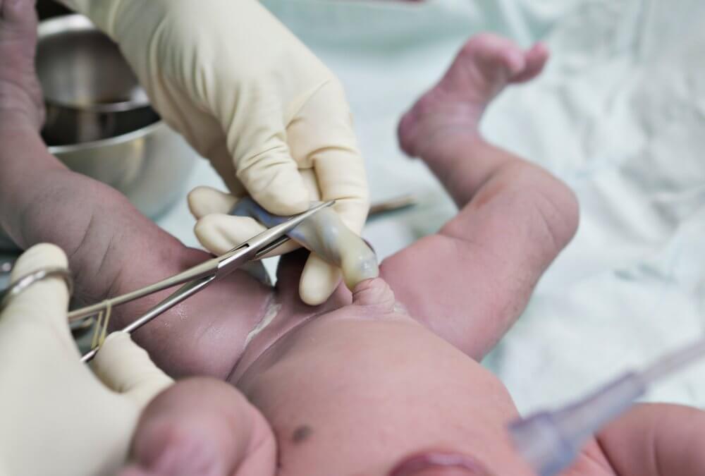 Delayed Cord Clamping