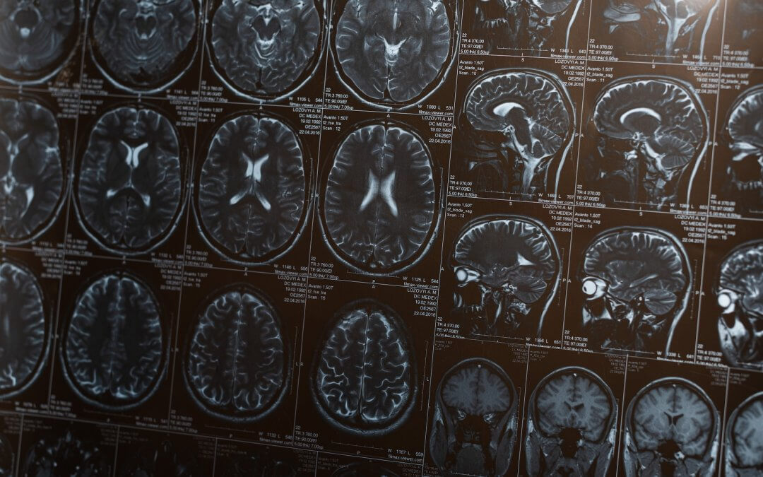 New Pioneering Technique for Treating Parkinson’s with Stem Cells
