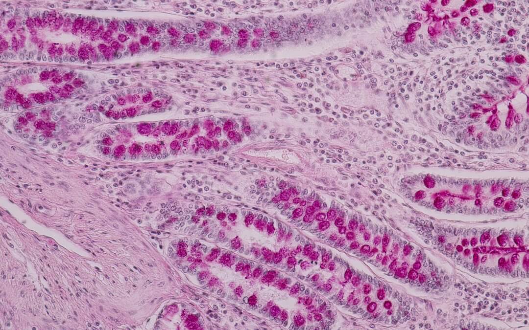 Researchers Investigate Use of Umbilical Cord Stem Cells for Crohn’s
