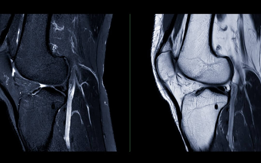 Growing Cartilage Using Stem Cells and 3D Printing