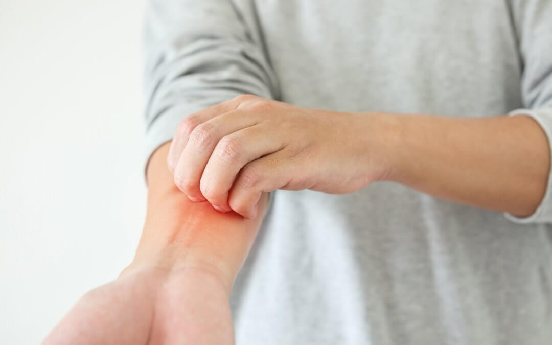 Promising Results of Stem Cell Eczema Treatment