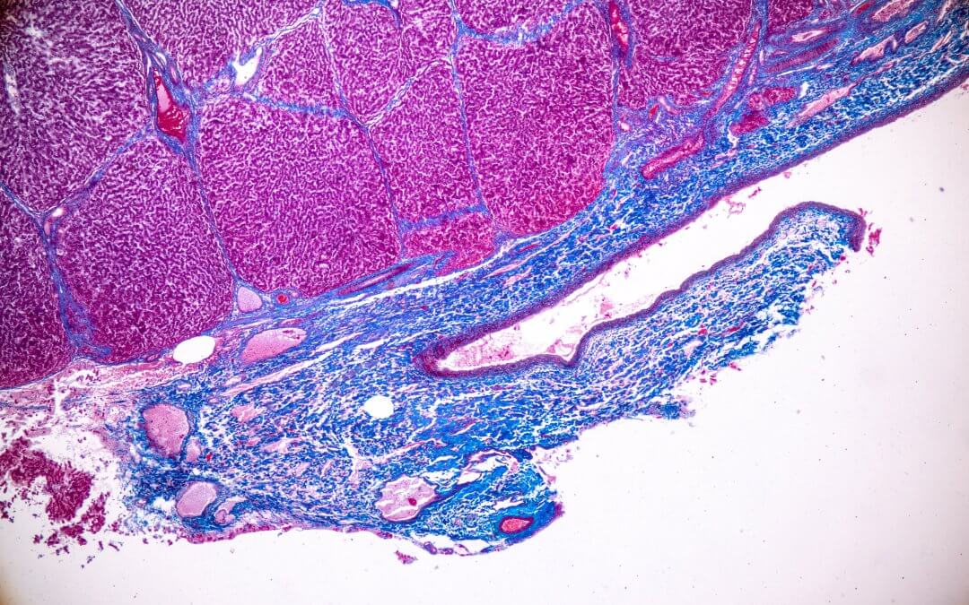 Stem Cell Therapy Could Treat Liver Cancer, Researchers Show
