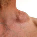 Swollen lymph node caused by lymphoma