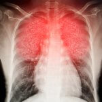 Respiratory distress illustration