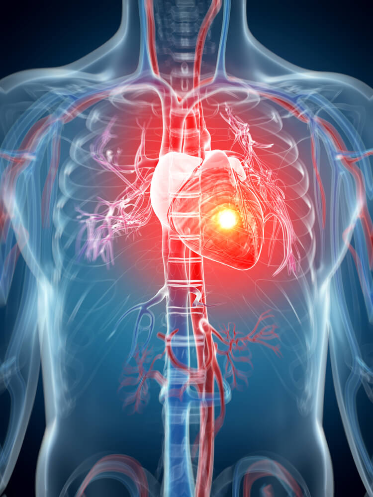 cardiac angina