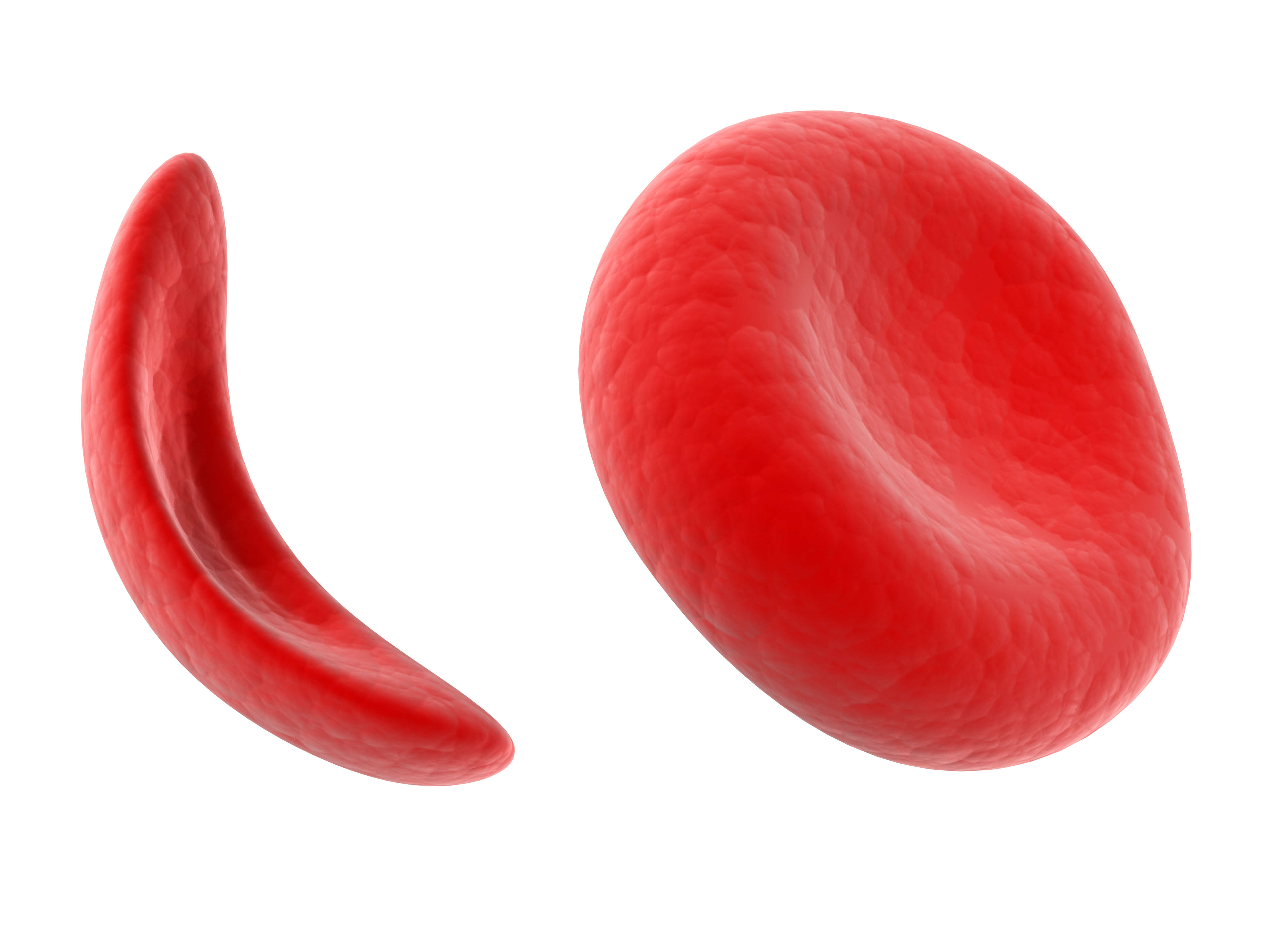 Sickle Cell Anaemia 