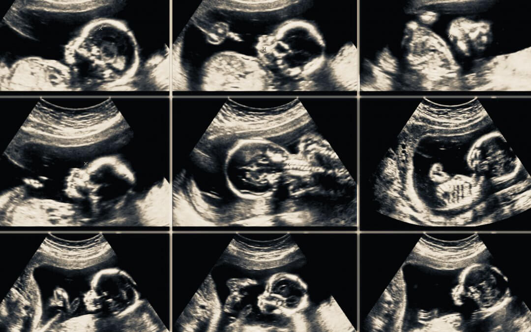 ultra sound scan showing pictures of a baby for use in a blog about placenta banking