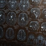 brain scans used by researchers for stem cell treatments for Parkinson's with hydrogel