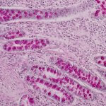 stomach or small intestine cells affected by crohn's disease, new stem cell treatment trial