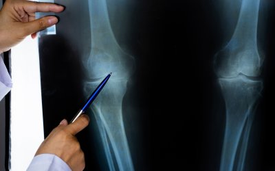 New Stem Cell Therapy Could Treat Osteoarthritis, Study Finds