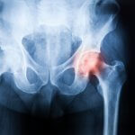 X-ray of pelvis and hip