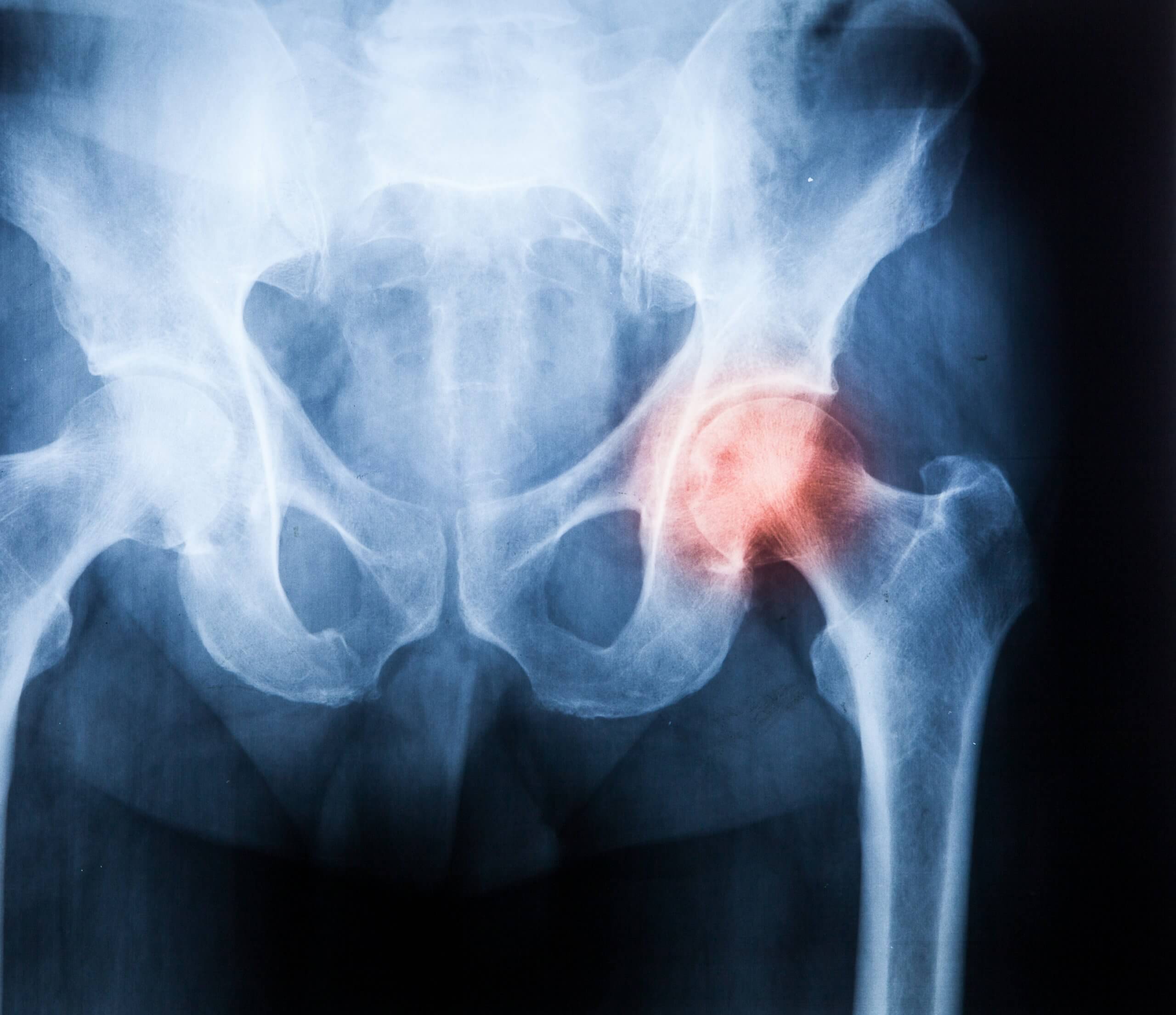 X-ray of pelvis and hip