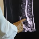 Doctor pointing to lumbar spinal cord MRI