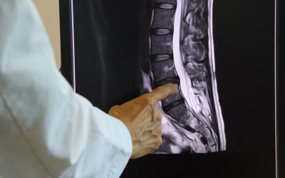 Combination Therapy Using Umbilical Cord Stem Cells Could Be Key to Treating Spinal Cord Injuries