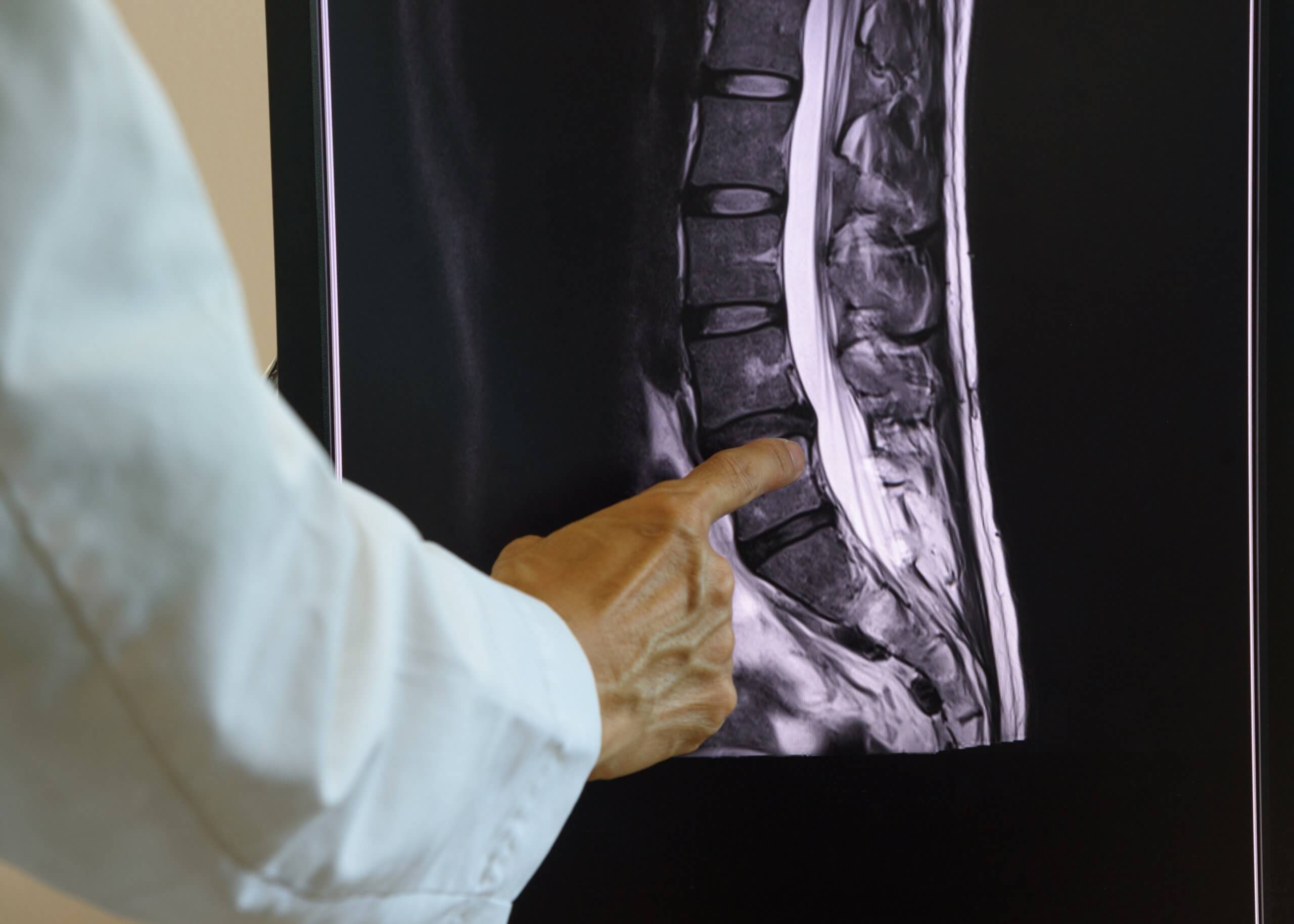 Doctor pointing to lumbar spinal cord MRI