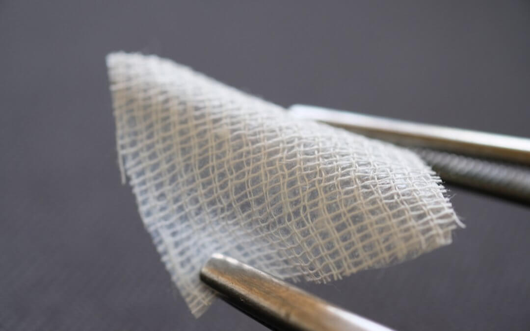 An amniotic membrane graft used for wound healing.