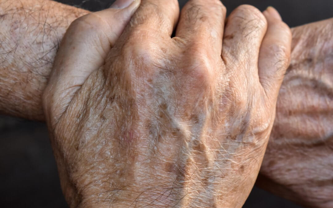 Sun-damaged skin on hands