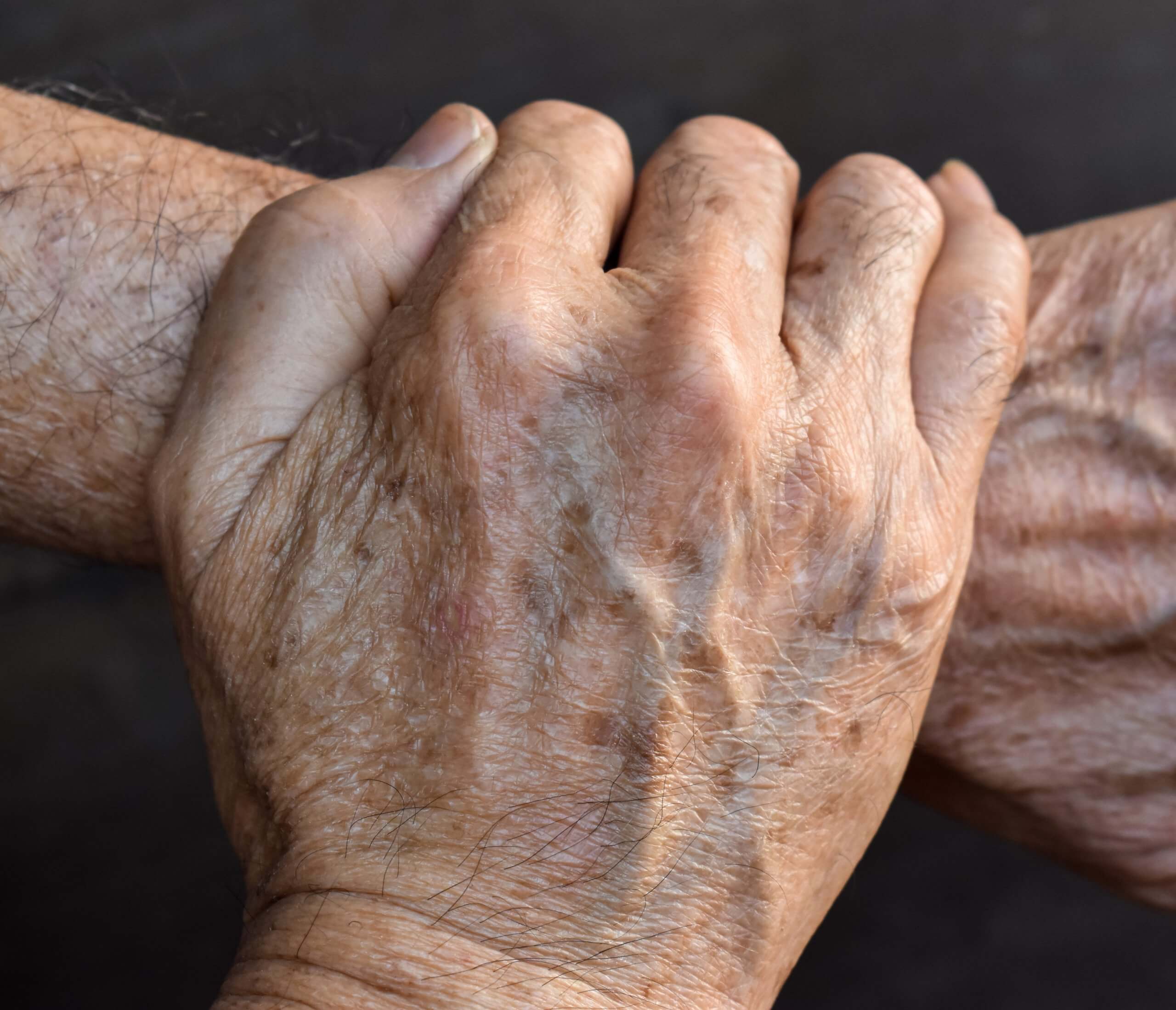 Sun-damaged skin on hands