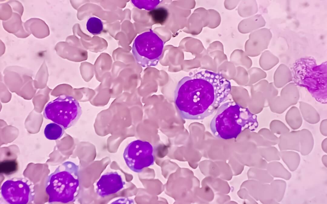 Acute lymphoblastic leukaemia clinical trials