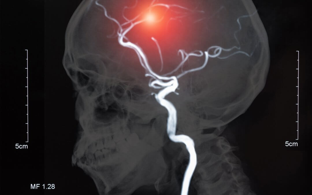 Stem Cell Therapy Offers Hope for Brain Recovery After Stroke