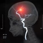 Stem cell stroke therapy