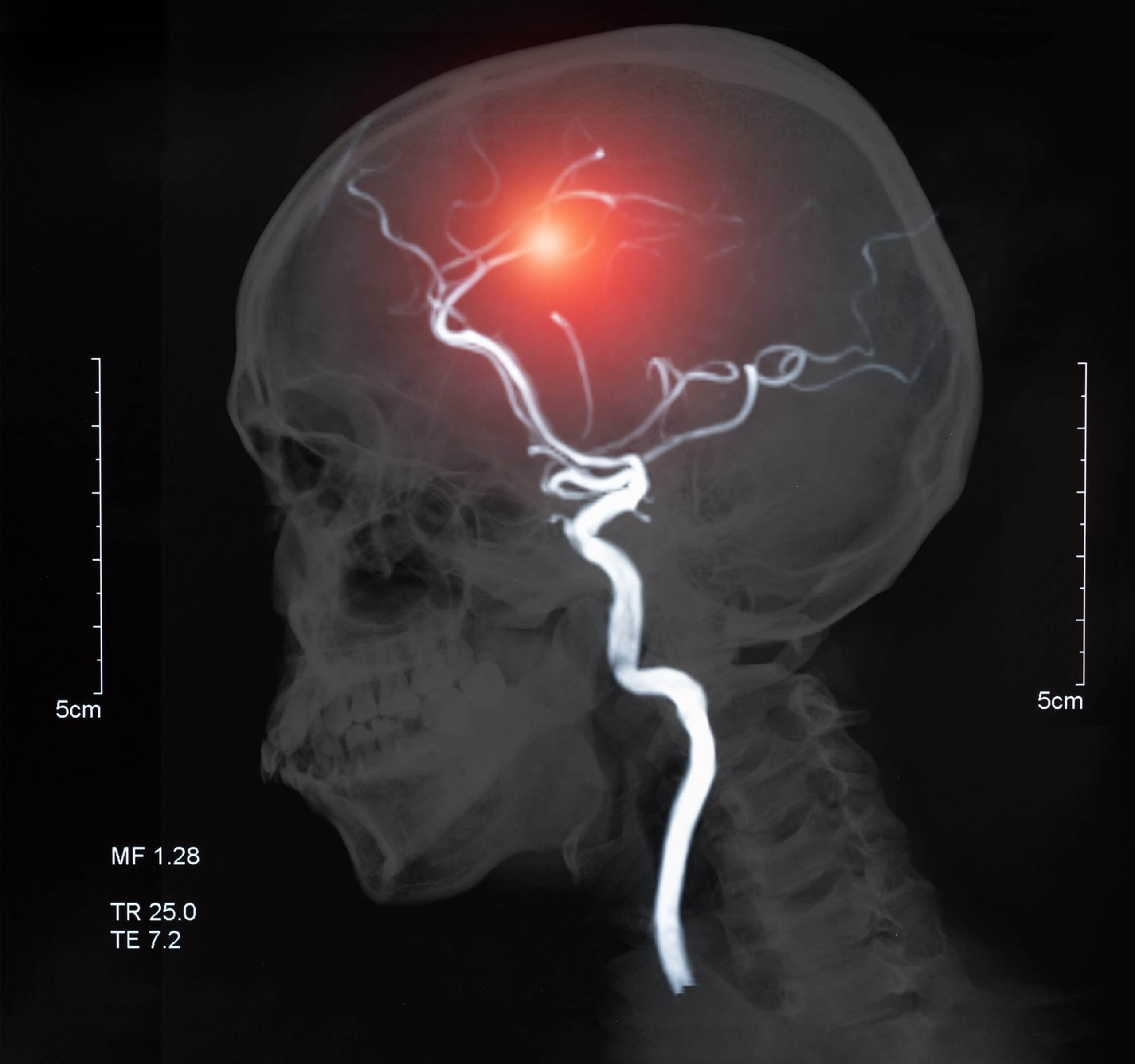 Stem cell stroke therapy