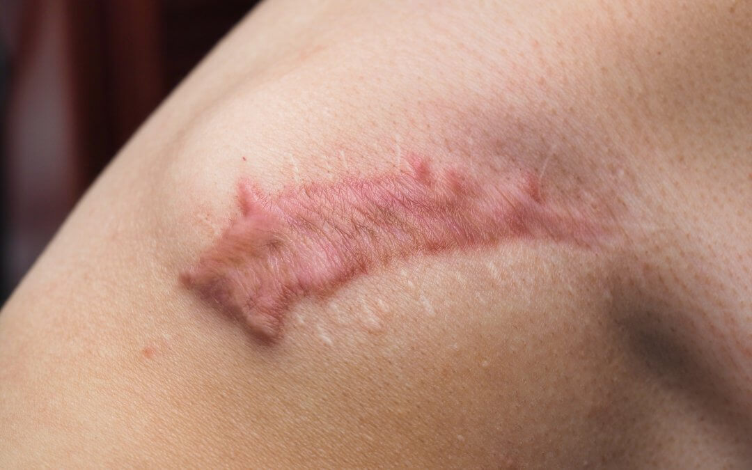 Photograph of a keloid scar