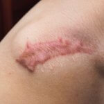 Photograph of a keloid scar