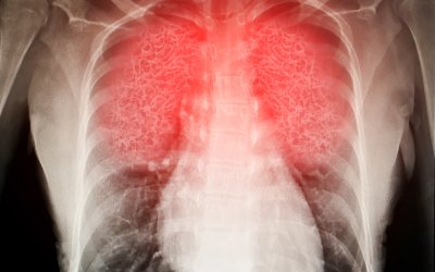 Could Stem Cells Help People in Respiratory Distress?