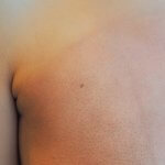 A photo of skin with radiation damage