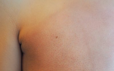 Placenta Stem Cell Gel Shows Promise for Skin Radiation Damage