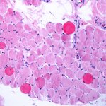 Duchenne muscular dystrophy, muscle fibres