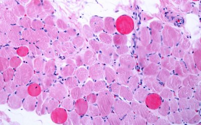 Stem Cell Therapy Potential for Duchenne Muscular Dystrophy