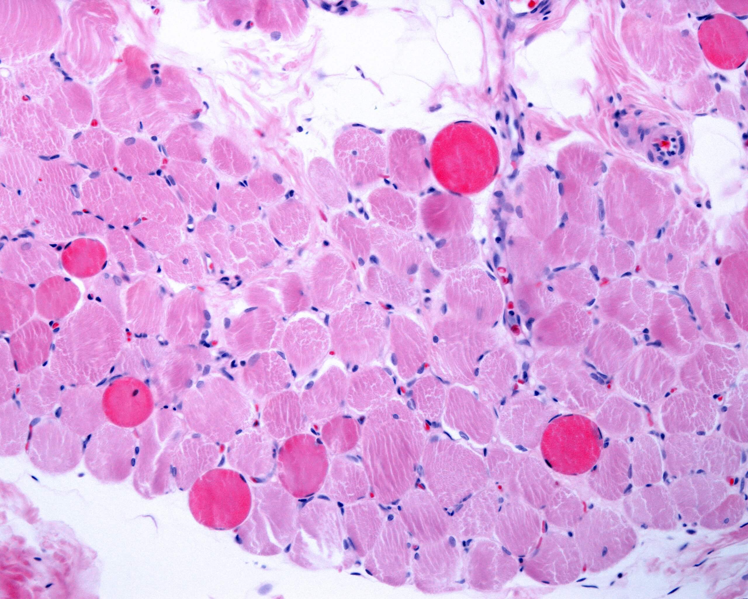 Duchenne muscular dystrophy, muscle fibres