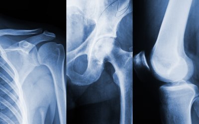 Iran Begins Treating Osteoarthritis With Umbilical Cord Stem Cells