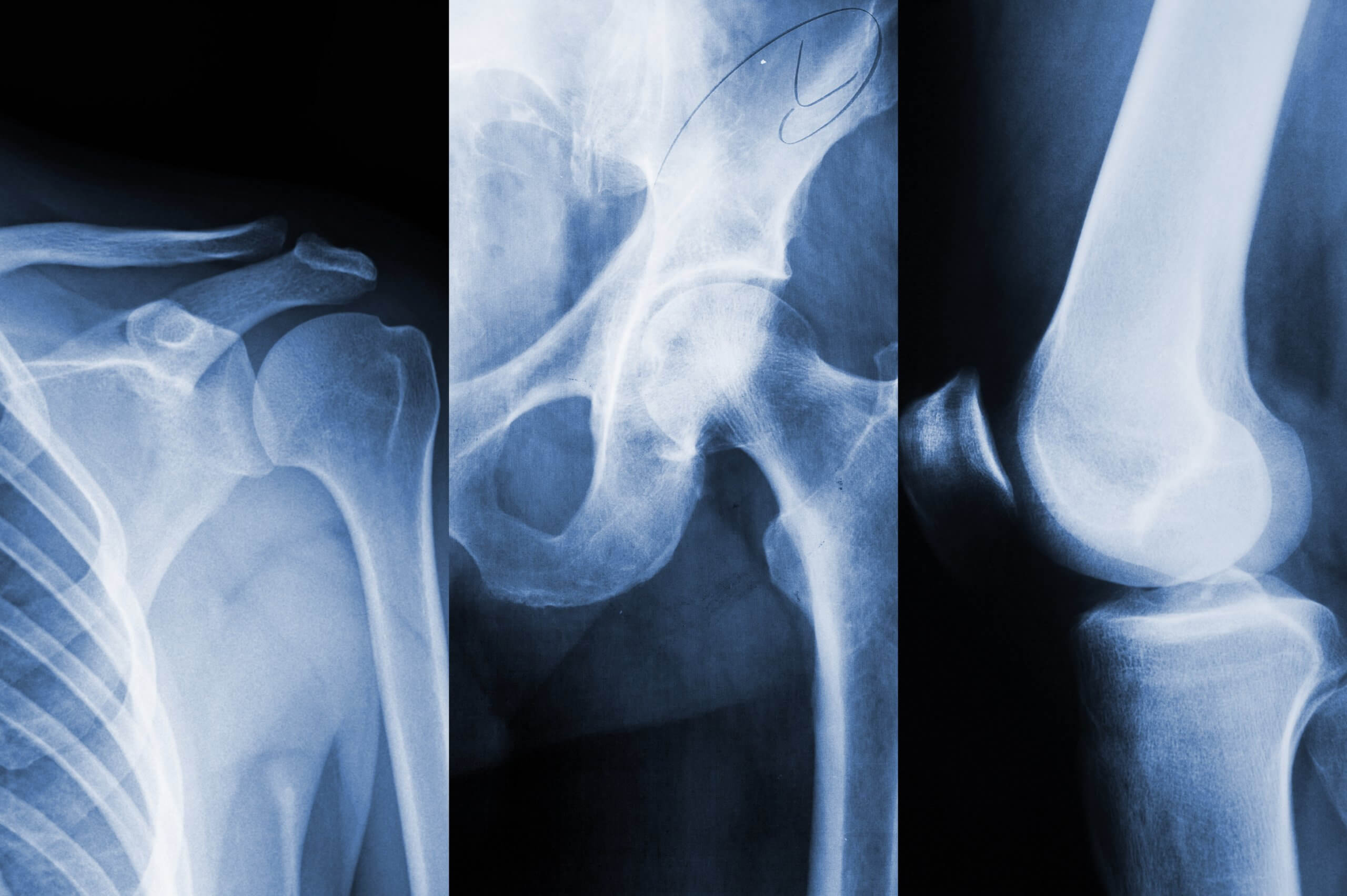 Shoulder, hip and knee joints x-ray illustration