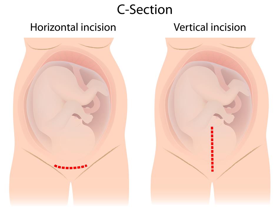 smaller_c_section_diagram.jpg